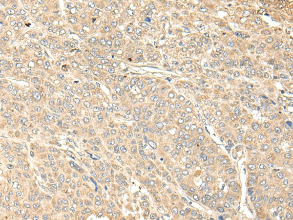 Immunohistochemistry of paraffin-embedded Human liver cancer tissue  using WDFY4 Polyclonal Antibody at dilution of 1:50(?200)