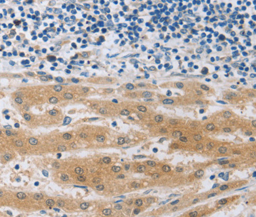 Immunohistochemistry of paraffin-embedded Human liver cancer using MUC20 Polyclonal Antibody at dilution of 1:40