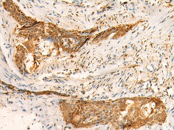 Immunohistochemistry of paraffin-embedded Human esophagus cancer tissue  using SMUG1 Polyclonal Antibody at dilution of 1:50(?200)