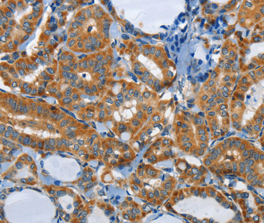 Immunohistochemistry of paraffin-embedded Human thyroid cancer tissue using PIK3R4 Polyclonal Antibody at dilution 1:85