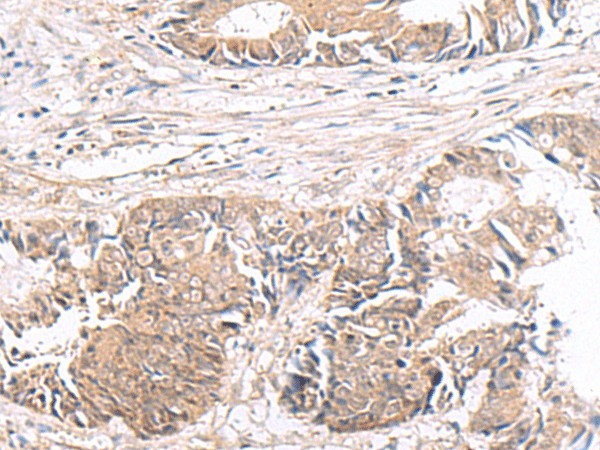 Immunohistochemistry of paraffin-embedded Human colorectal cancer tissue  using HMGCLL1 Polyclonal Antibody at dilution of 1:60(?200)