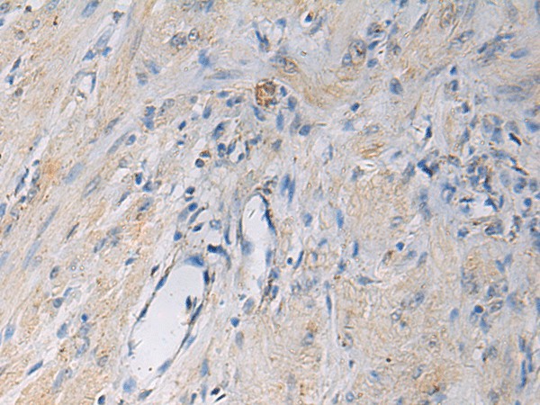 Immunohistochemistry of paraffin-embedded Human gastric cancer tissue  using HSDL2 Polyclonal Antibody at dilution of 1:55(?200)