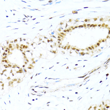 Immunohistochemistry of paraffin-embedded Human breast cancer using XRCC4 Polyclonal Antibody at dilution of 1:100 (40x lens).