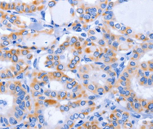 Immunohistochemistry of paraffin-embedded Human thyroid cancer using GFER Polyclonal Antibody at dilution of 1:50