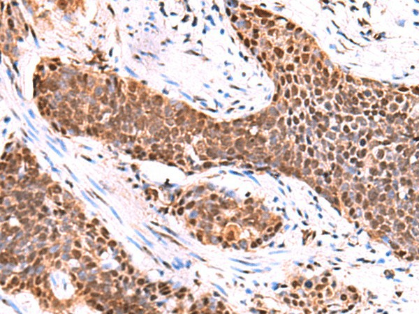 Immunohistochemistry of paraffin-embedded Human esophagus cancer tissue  using TSEN2 Polyclonal Antibody at dilution of 1:80(?200)