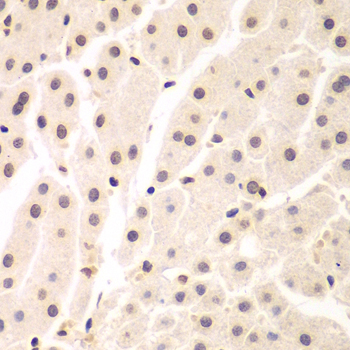 Immunohistochemistry of paraffin-embedded Human liver cancer using UHRF2 Polyclonal Antibody at dilution of 1:200 (40x lens).