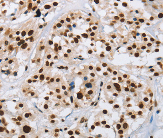 Immunohistochemistry of paraffin-embedded Human thyroid cancer using IL17C Polyclonal Antibody at dilution of 1:50