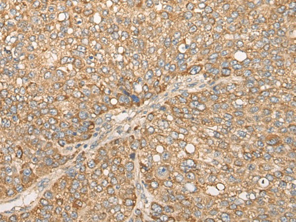 Immunohistochemistry of paraffin-embedded Human liver cancer tissue  using CAPN15 Polyclonal Antibody at dilution of 1:50(?200)