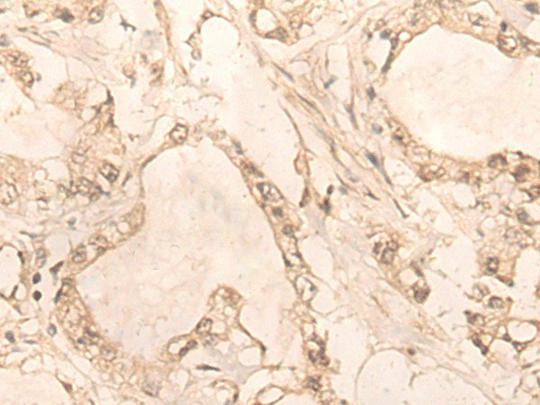 Immunohistochemistry of paraffin-embedded Human gastric cancer tissue  using PLEKHA1 Polyclonal Antibody at dilution of 1:30(?200)