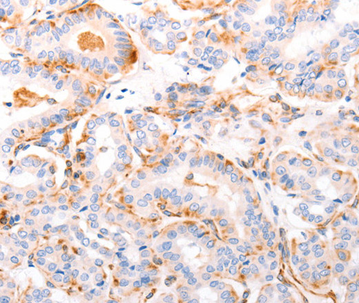 Immunohistochemistry of paraffin-embedded Human thyroid cancer using ABCA4 Polyclonal Antibody at dilution of 1:30