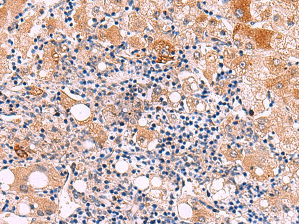 Immunohistochemistry of paraffin-embedded Human liver cancer tissue  using KATNAL1 Polyclonal Antibody at dilution of 1:80(?200)