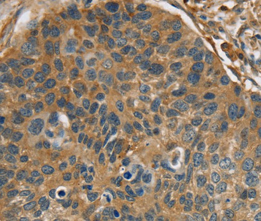 Immunohistochemistry of paraffin-embedded Human esophagus cancer tissue using RIPK4 Polyclonal Antibody at dilution 1:40