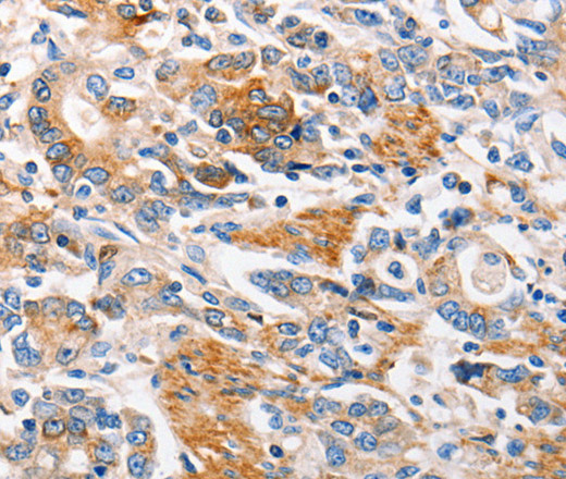 Immunohistochemistry of paraffin-embedded Human gasrtic cancer tissue using MC1R Polyclonal Antibody at dilution 1:100