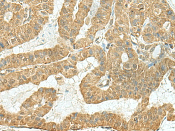 Immunohistochemistry of paraffin-embedded Human thyroid cancer tissue  using TENT5C Polyclonal Antibody at dilution of 1:110(?200)