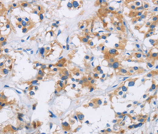 Immunohistochemistry of paraffin-embedded Human thyroid cancer tissue using IAPP Polyclonal Antibody at dilution 1:40