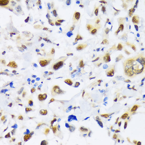 Immunohistochemistry of paraffin-embedded Human lung cancer using EP300 Polyclonal Antibody at dilution of  1:100 (40x lens).