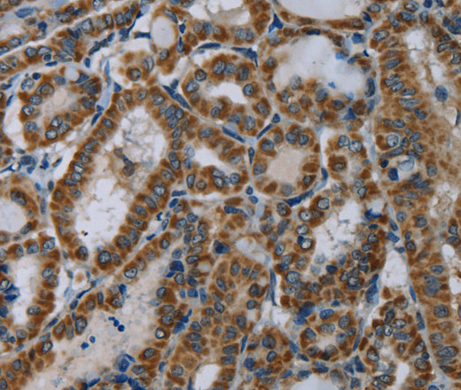 Immunohistochemistry of paraffin-embedded Human thyroid cancer using NDUFA5 Polyclonal Antibody at dilution of 1:60