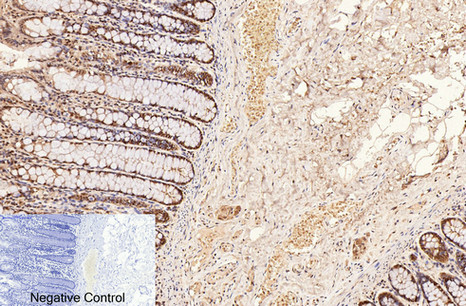 Immunohistochemistry of paraffin-embedded Human colon tissue using CD2 Monoclonal Antibody at dilution of 1:200.