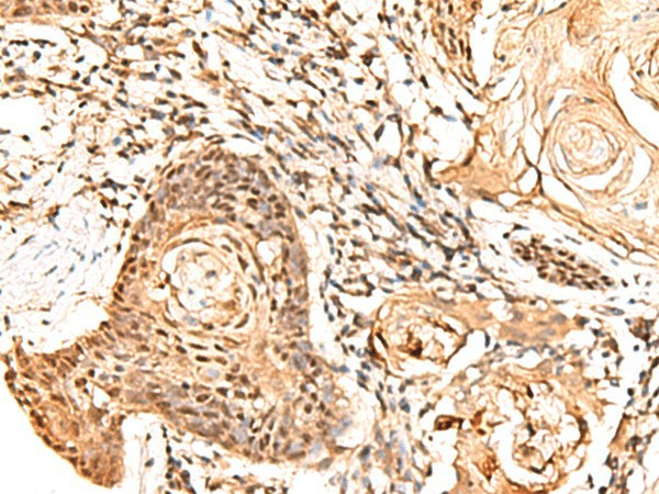 Immunohistochemistry of paraffin-embedded Human esophagus cancer tissue  using RETREG1 Polyclonal Antibody at dilution of 1:60(?200)