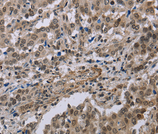 Immunohistochemistry of paraffin-embedded Human liver cancer tissue using MGLL Polyclonal Antibody at dilution 1:40