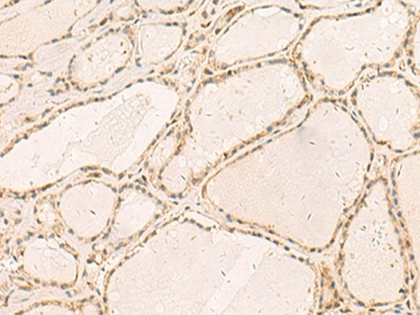 Immunohistochemistry of paraffin-embedded Human thyroid cancer tissue  using RFX6 Polyclonal Antibody at dilution of 1:50(?200)