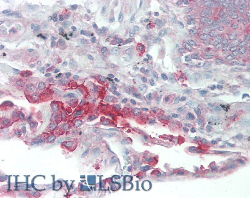 Immunohistochemistry of paraffin-embedded Human Lung tissue using SLC34A2 Polyclonal Antibody at dilution of 1:60(Elabscience Product Detected by Lifespan).