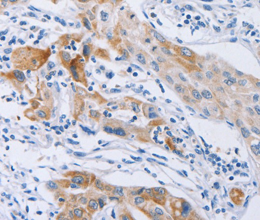 Immunohistochemistry of paraffin-embedded Human lung cancer using CDC27 Polyclonal Antibody at dilution of 1:40