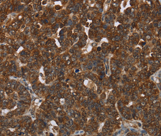 Immunohistochemistry of paraffin-embedded Human cervical cancer using CERS5 Polyclonal Antibody at dilution of 1:35