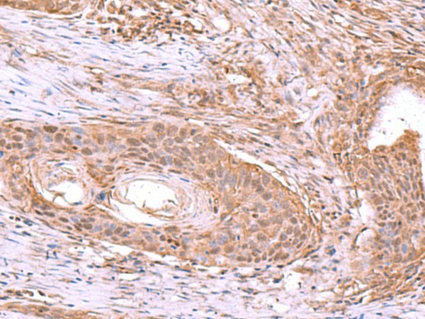 Immunohistochemistry of paraffin-embedded Human esophagus cancer tissue  using JDP2 Polyclonal Antibody at dilution of 1:40(?200)