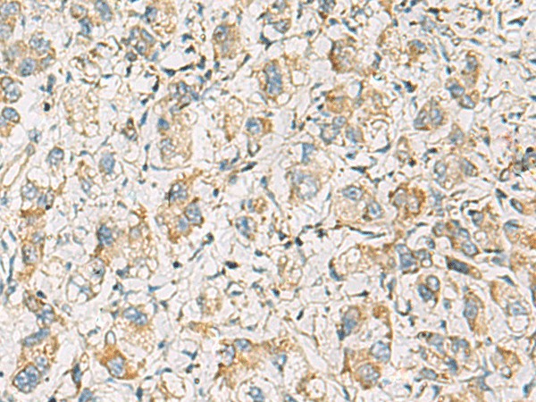 Immunohistochemistry of paraffin-embedded Human liver cancer tissue  using PDE4DIP Polyclonal Antibody at dilution of 1:60(?200)