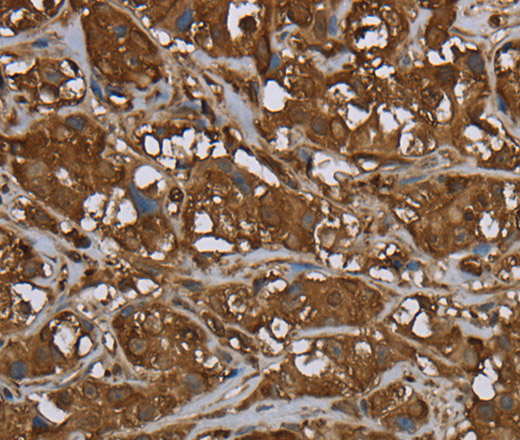 Immunohistochemistry of paraffin-embedded Human breast cancer using ARHGDIA Polyclonal Antibody at dilution of 1:50