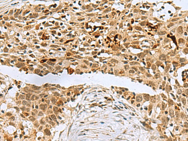 Immunohistochemistry of paraffin-embedded Human esophagus cancer tissue  using BCL7B Polyclonal Antibody at dilution of 1:60(?200)