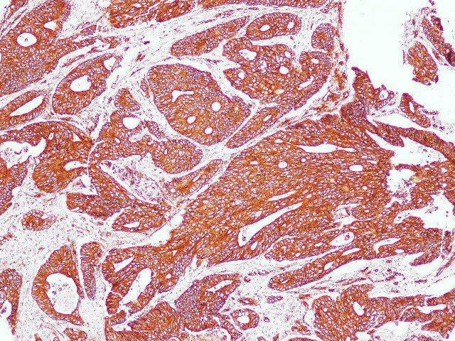 Immunohistochemistry of paraffin-embedded Human carcinoma of Colon using Sptan1 Polyclonal Antibody at dilution of 1:100 (100 x)