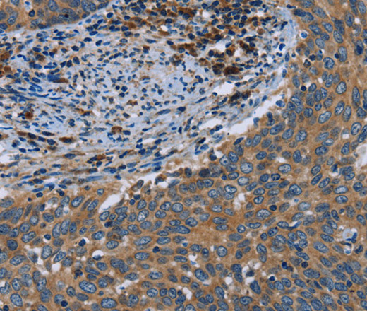 Immunohistochemistry of paraffin-embedded Human cervical cancer using HYAL3 Polyclonal Antibody at dilution of 1:40