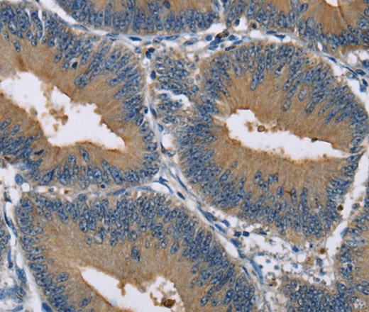 Immunohistochemistry of paraffin-embedded Human colon cancer tissue using GAB1 Polyclonal Antibody at dilution 1:40