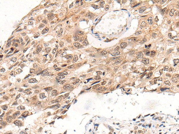 Immunohistochemistry of paraffin-embedded Human esophagus cancer tissue  using KNOP1 Polyclonal Antibody at dilution of 1:85(?200)