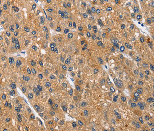 Immunohistochemistry of paraffin-embedded Human liver cancer tissue using CEACAM3 Polyclonal Antibody at dilution 1:70