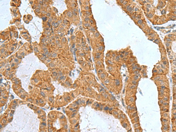 Immunohistochemistry of paraffin-embedded Human thyroid cancer tissue  using ITGB1BP1 Polyclonal Antibody at dilution of 1:50(?200)