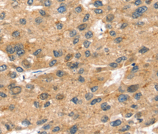 Immunohistochemistry of paraffin-embedded Human liver cancer using SORT1 Polyclonal Antibody at dilution of 1:35