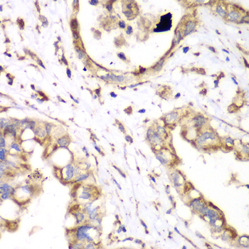 Immunohistochemistry of paraffin-embedded Human liver cancer using HADHA Polyclonal Antibody at dilution of 1:100 (40x lens).
