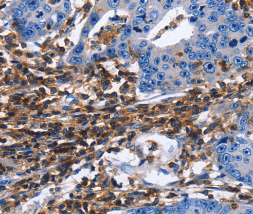 Immunohistochemistry of paraffin-embedded Human gastric cancer tissue using CD45 Polyclonal Antibody at dilution 1:40