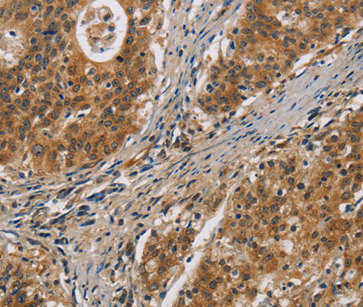 Immunohistochemistry of paraffin-embedded Human gastric cancer tissue using IL17D Polyclonal Antibody at dilution 1:50