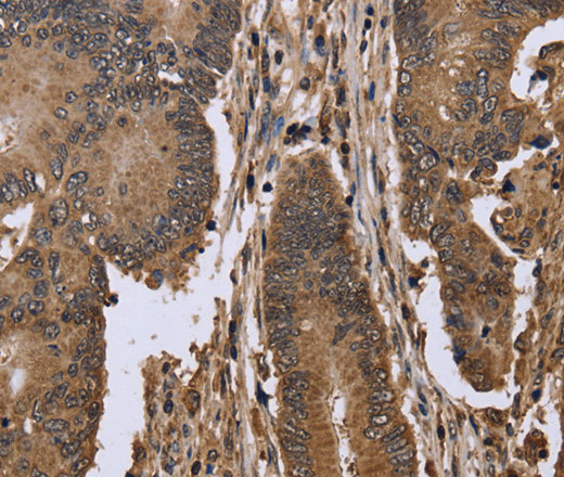 Immunohistochemistry of paraffin-embedded Human colon cancer using EIF3H Polyclonal Antibody at dilution of 1:50