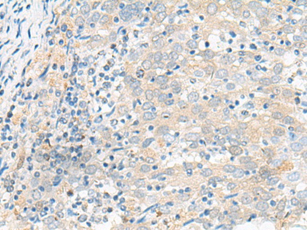 Immunohistochemistry of paraffin-embedded Human cervical cancer tissue  using FGR Polyclonal Antibody at dilution of 1:70(?200)