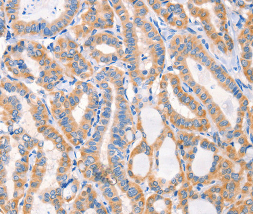 Immunohistochemistry of paraffin-embedded Human thyroid cancer tissue using Factor XIIIa Polyclonal Antibody at dilution 1:80