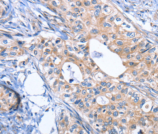 Immunohistochemistry of paraffin-embedded Human cervical cancer using INHBC Polyclonal Antibody at dilution of 1:50