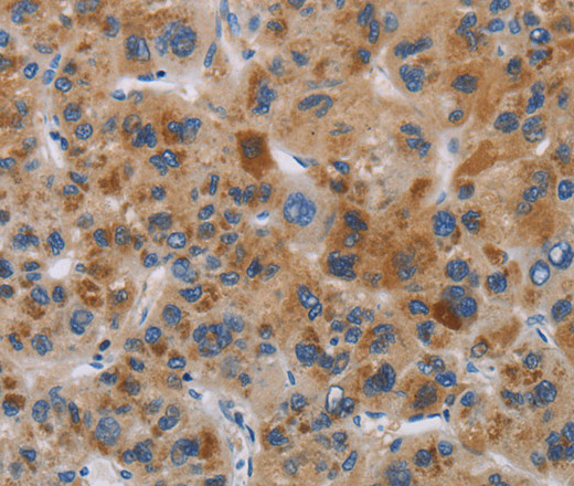 Immunohistochemistry of paraffin-embedded Human liver cancer tissue using IAPP Polyclonal Antibody at dilution 1:40