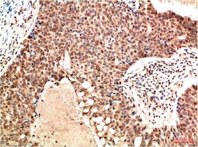 Immunohistochemistry of paraffin-embedded Human breast carcinoma tissue using ATM Monoclonal Antibody at dilution of 1:200.