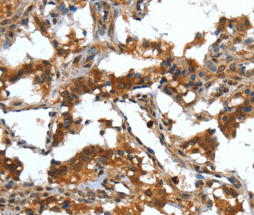 Immunohistochemistry of paraffin-embedded Human thyroid cancer tissue using DEFA4 Polyclonal Antibody at dilution 1:40