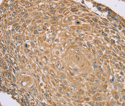 Immunohistochemistry of paraffin-embedded Human lung cancer tissue using RNF148 Polyclonal Antibody at dilution 1:45